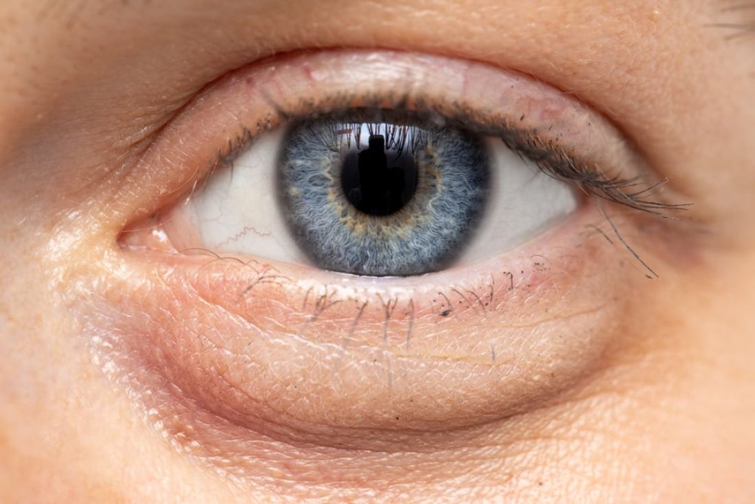 Tränensäcke - Fettgewebe unter den Augen