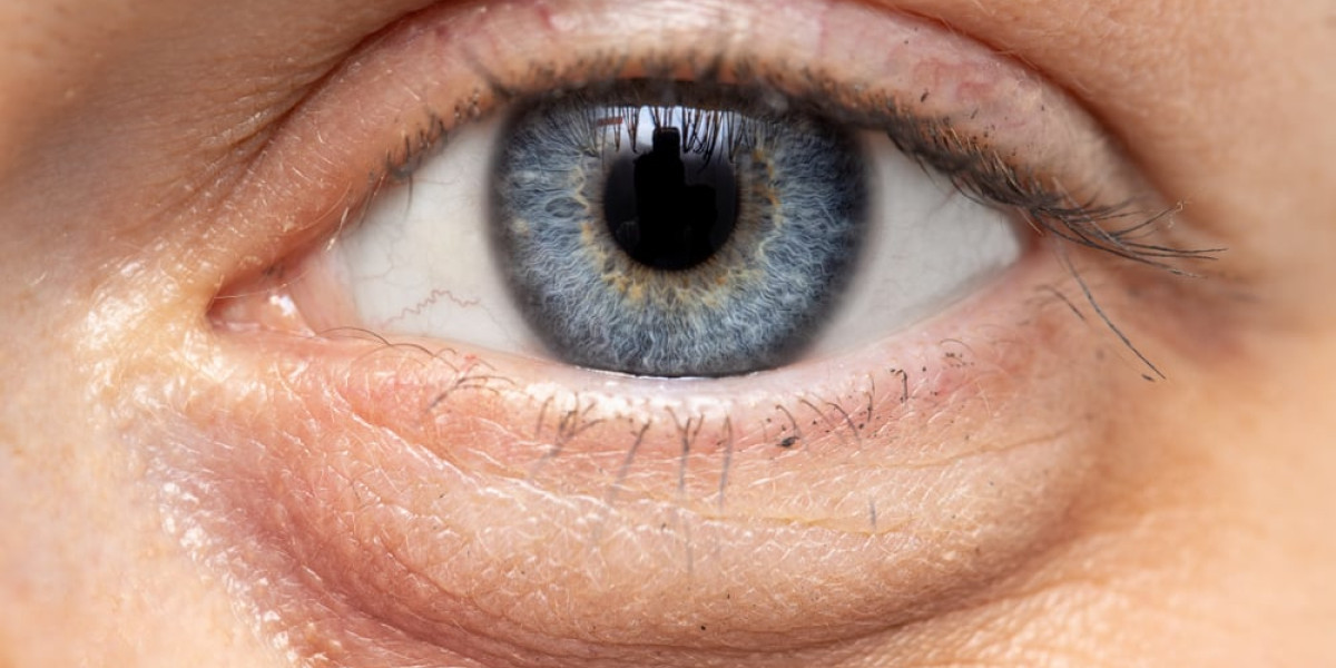 Tränensäcke - Fettgewebe unter den Augen