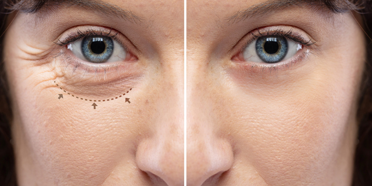 Tränensäcke vorher nachher