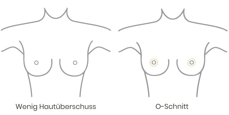 Grafik O-Schnitt Bruststraffung